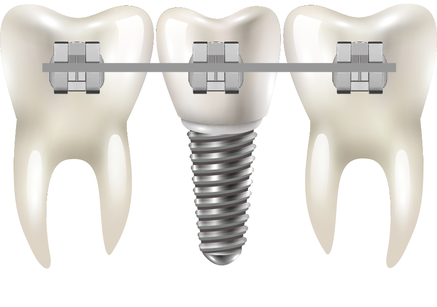 Imagem do logo com três dentes, sendo o do meio, um implante